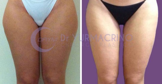 Liposcultura Gambe/Glutei – Caso 13/A