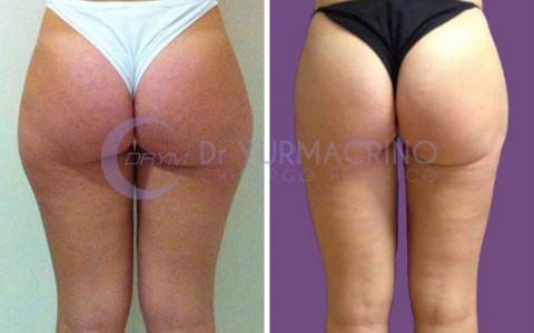 Liposcultura Gambe/Glutei – Caso 13/B