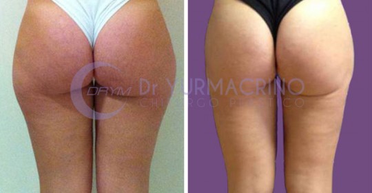 Liposcultura Gambe/Glutei – Caso 13/B