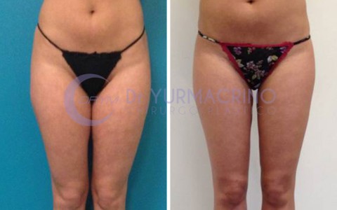 Liposcultura Gambe/Glutei – Caso 14/A