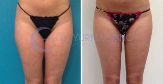 Liposcultura Gambe/Glutei – Caso 14/A