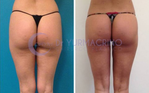 Liposcultura Gambe/Glutei – Caso 14/B