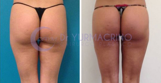 Liposcultura Gambe/Glutei – Caso 14/B