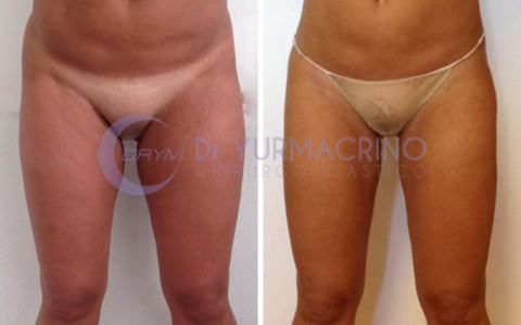 Liposcultura Gambe/Glutei – Caso 15/A