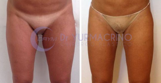 Liposcultura Gambe/Glutei – Caso 15/A