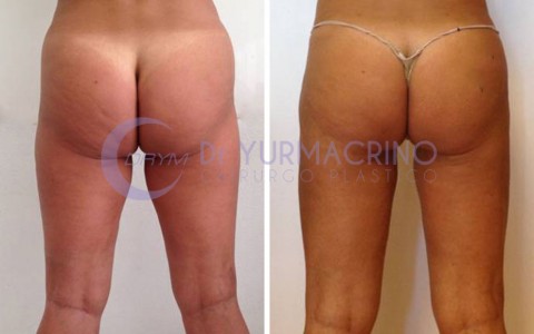 Liposcultura Gambe/Glutei – Caso 15/B