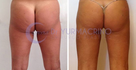 Liposcultura Gambe/Glutei – Caso 15/B