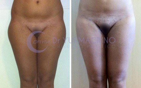 Liposcultura Gambe/Glutei – Caso 16/A