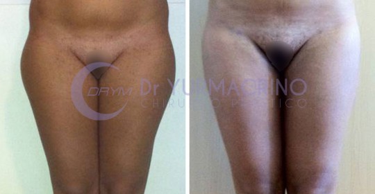 Liposcultura Gambe/Glutei – Caso 16/A