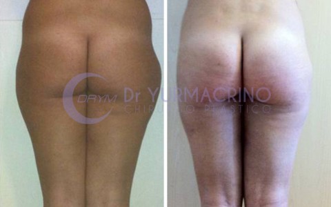 Liposcultura Gambe/Glutei – Caso 16/B