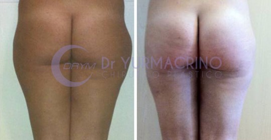 Liposcultura Gambe/Glutei – Caso 16/B