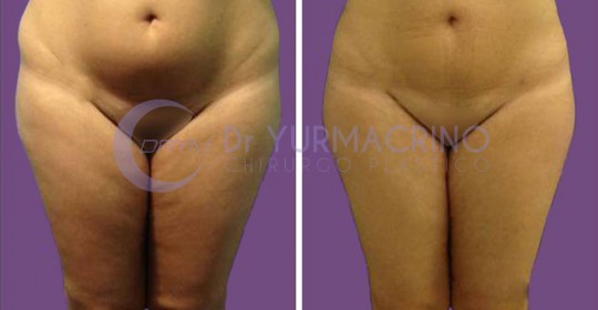 Liposcultura Gambe/Glutei – Caso 17/A