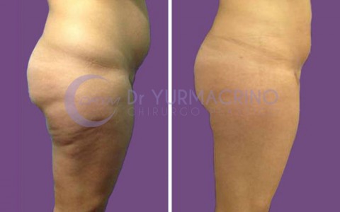 Liposcultura Gambe/Glutei – Caso 17/B