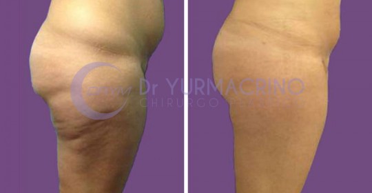 Liposcultura Gambe/Glutei – Caso 17/B