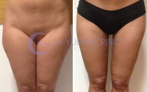 Liposcultura Gambe/Glutei – Caso 18/A