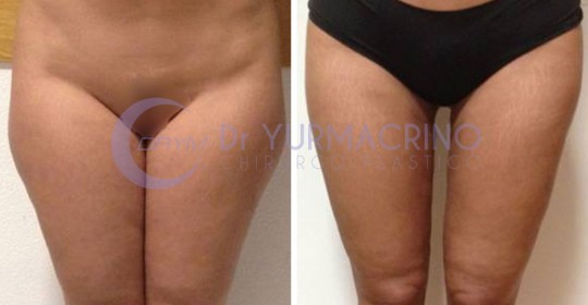 Liposcultura Gambe/Glutei – Caso 18/A