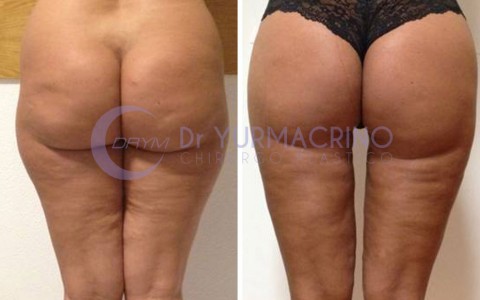 Liposcultura Gambe/Glutei – Caso 18/B