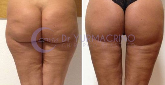 Liposcultura Gambe/Glutei – Caso 18/B