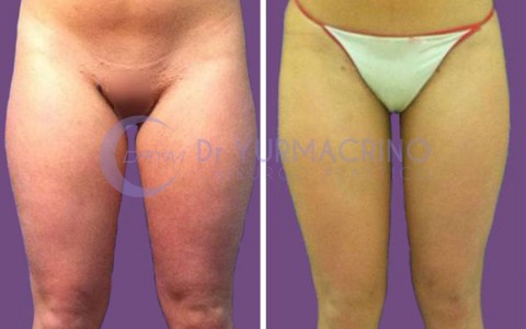 Liposcultura Gambe/Glutei – Caso 19/A