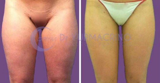 Liposcultura Gambe/Glutei – Caso 19/A