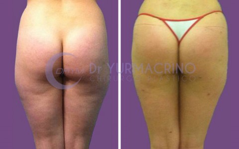 Liposcultura Gambe/Glutei – Caso 19/B