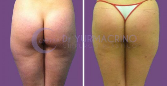 Liposcultura Gambe/Glutei – Caso 19/B