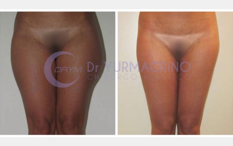 Liposcultura Gambe/Glutei – Caso 20/A