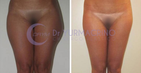 Liposcultura Gambe/Glutei – Caso 20/A