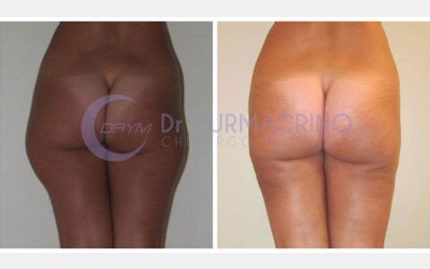 Liposcultura Gambe/Glutei – Caso 20/B