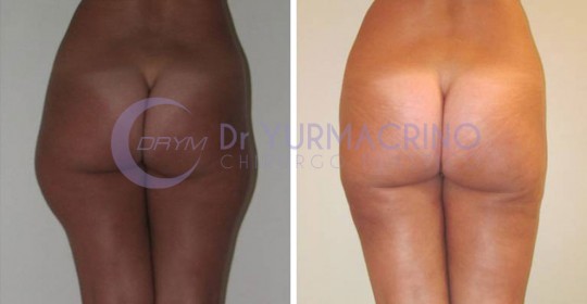 Liposcultura Gambe/Glutei – Caso 20/B