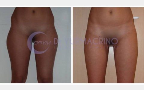 Liposcultura Gambe/Glutei – Caso 21/A