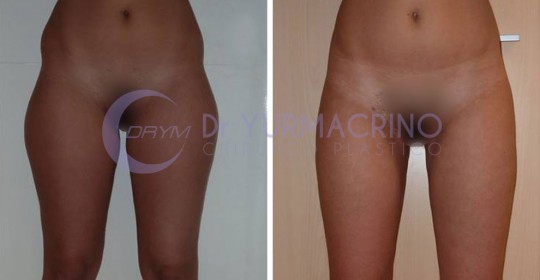 Liposcultura Gambe/Glutei – Caso 21/A