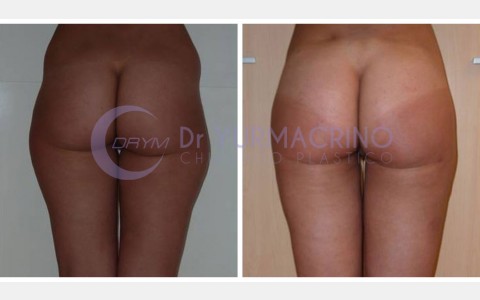 Liposcultura Gambe/Glutei – Caso 21/B