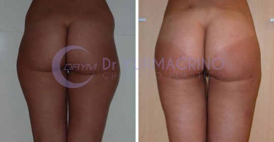 Liposcultura Gambe/Glutei – Caso 21/B