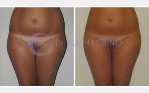 Liposcultura Gambe/Glutei – Caso 22/A