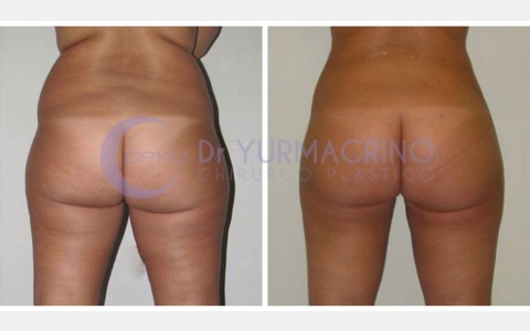 Liposcultura Gambe/Glutei – Caso 22/B