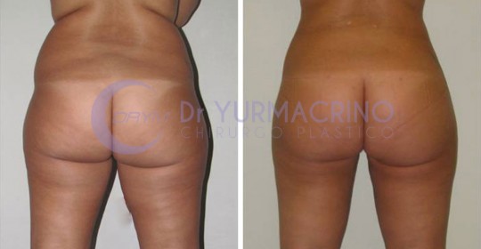 Liposcultura Gambe/Glutei – Caso 22/B