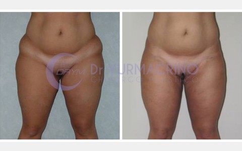 Liposcultura Gambe/Glutei – Caso 23/A