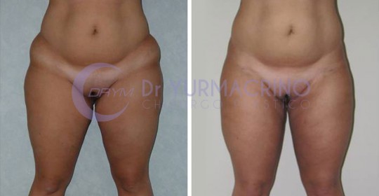 Liposcultura Gambe/Glutei – Caso 23/A