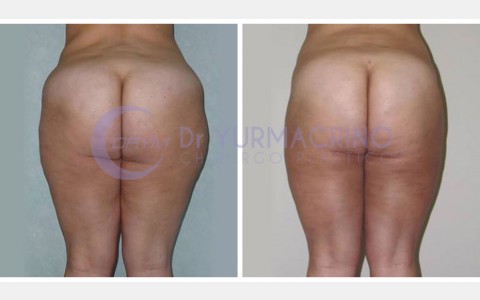 Liposcultura Gambe/Glutei – Caso 23/B