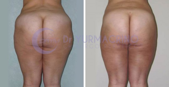 Liposcultura Gambe/Glutei – Caso 23/B