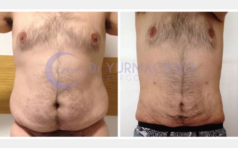 Man Liposculpture – Case 1/A