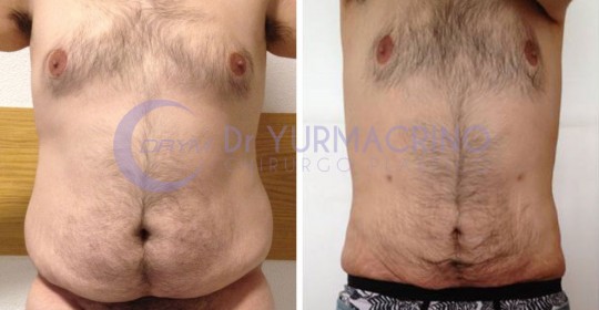 Man Liposculpture – Case 1/A