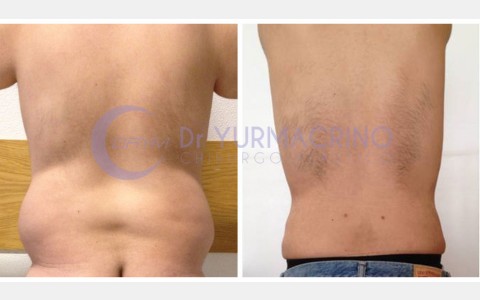 Man Liposculpture – Case 1/B