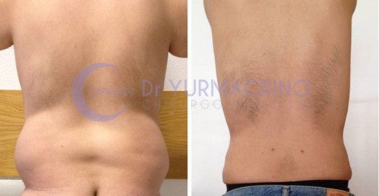 Liposcultura Uomo – Caso 1/B