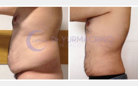 Man Liposculpture – Case 1/C