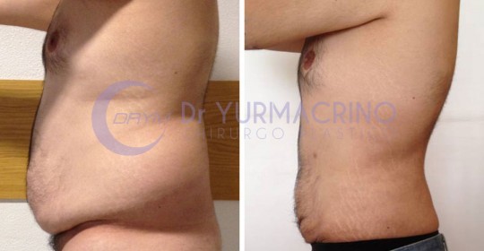 Liposcultura Uomo – Caso 1/C