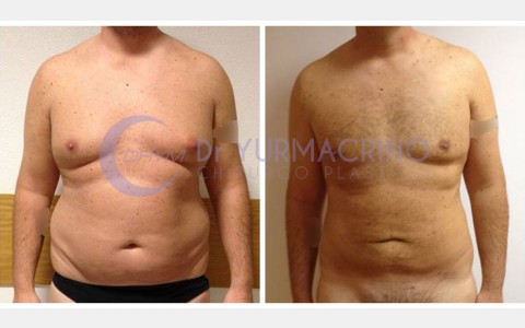 Man Liposculpture – Case 2/A