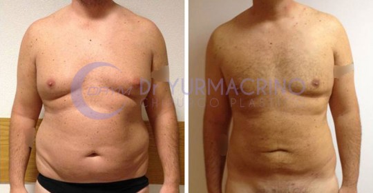 Man Liposculpture – Case 2/A