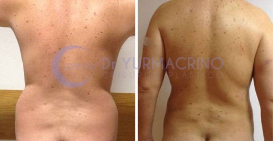 Liposcultura Uomo – Caso 2/B